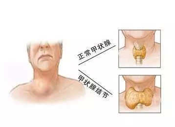 蘇州國(guó)醫(yī)堂張禾：如何預防甲狀腺結節(圖1)