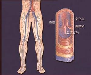 生活中導緻脈管炎的原因有哪些？蘇州怎麽治療？(圖1)